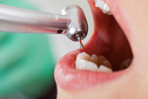 Best Urgent Care for Lost Fillings or Crowns in South Wilton, CT